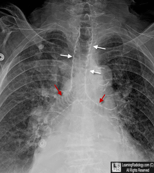 tracheal ring calcification
